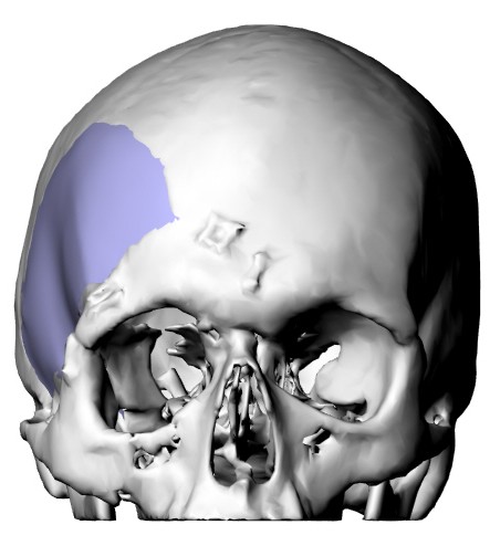 Cranial defect reconstruction