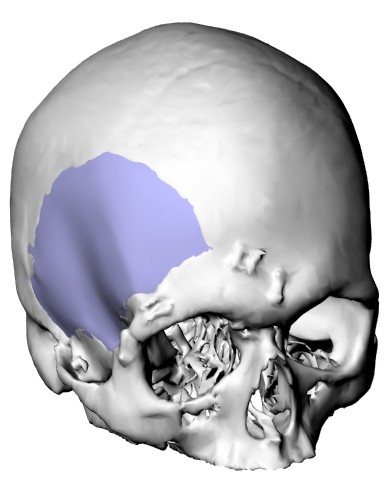 Cranial defect reconstruction